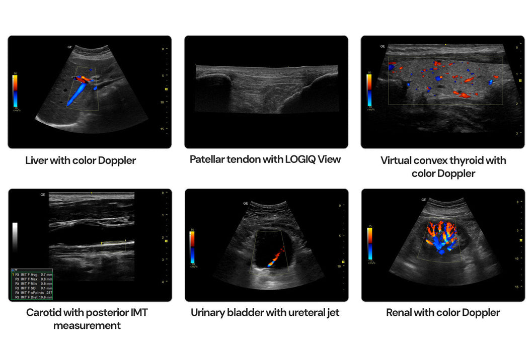 Versana Balance V2 Ultrasound