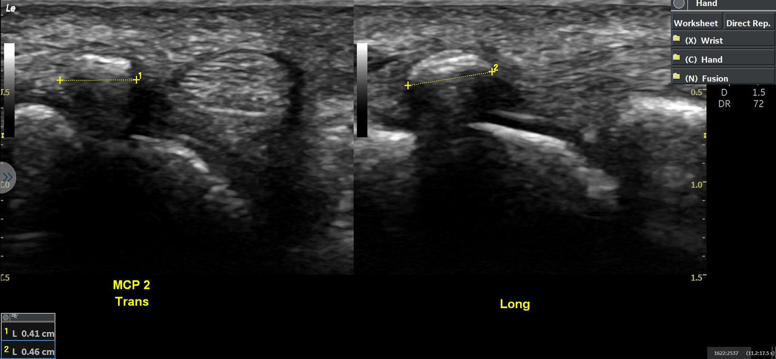 LOGIQ E Ultrasound