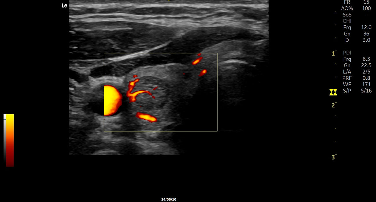 LOGIQ E Ultrasound