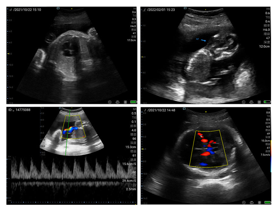 P50 Soloscan Handheld WiFi Ultrasound Scanner